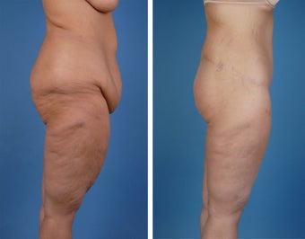 Lower Body Lift and Thighplasty
