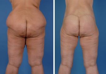 Lower Body Lift and Thighplasty