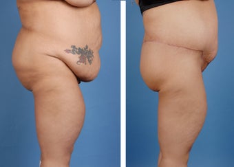 Lower Body Lift and Extended Tummy Tuck