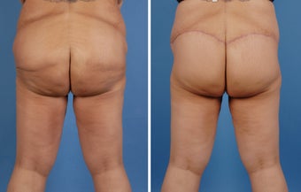 Lower Body Lift and Extended Tummy Tuck