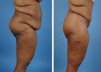 Lower Body Lift with Laser Liposuction to the Hips and Thighs