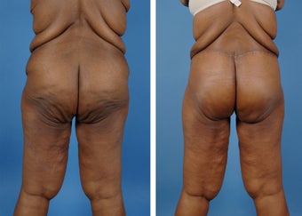 Lower Body Lift with Laser Liposuction to the Hips and Thighs