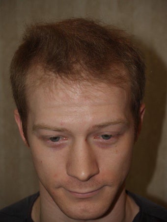 Hair Transplant 