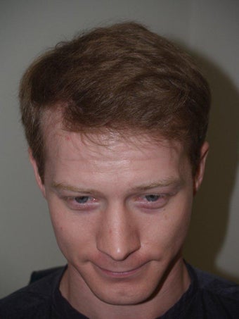 Hair Transplant 