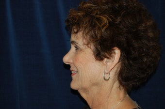 Facelift