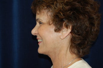 Facelift