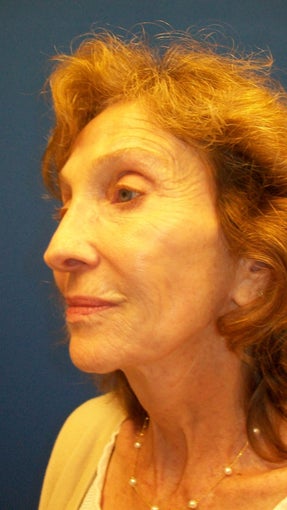 Sculptra