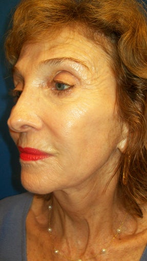Sculptra