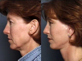 Brow Lift