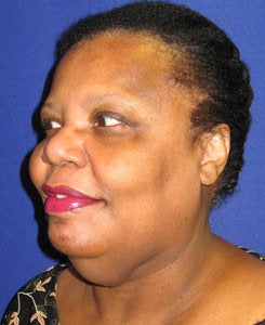 Face Lift, Neck Lift, Neck Liposuction