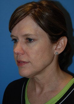 Face Lift, Neck Lift, Brow Lift