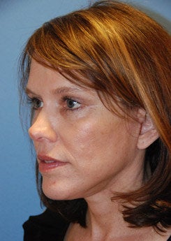 Face Lift, Neck Lift, Brow Lift