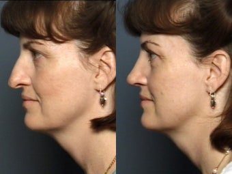 Nose Surgery