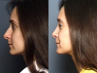 Nose Surgery
