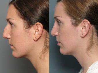 Nose Surgery