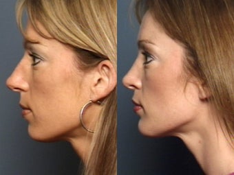 Nose Surgery