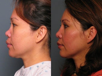 Nose Surgery