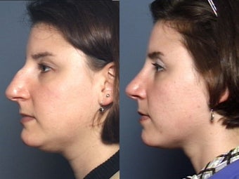 Nose Surgery