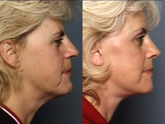Brow Lift