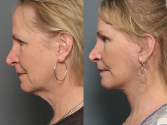 Brow Lift
