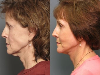 Brow lift