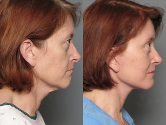 Brow Lift