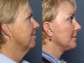 Brow Lift