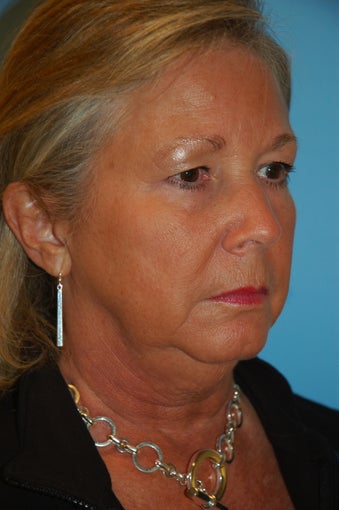 Facelift