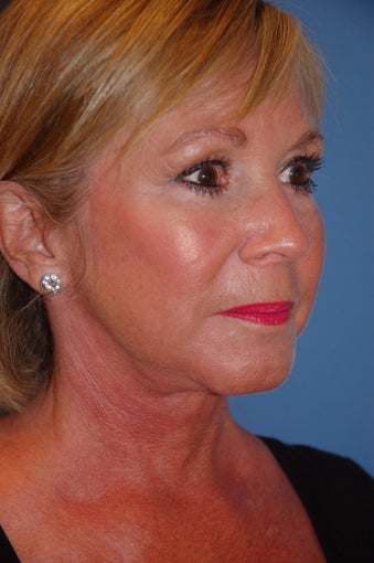 Facelift