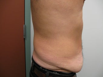 Abdominoplasty on 42 Year Old Male
