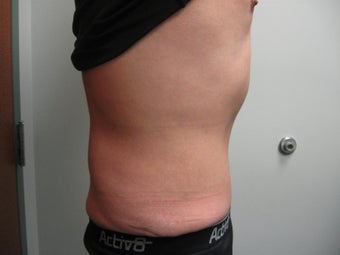 Abdominoplasty on 42 Year Old Male