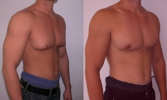 Gynecomastia 