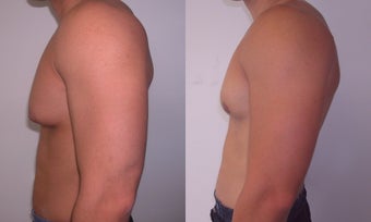 Gynecomastia 