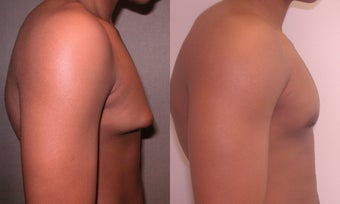 Gynecomastia