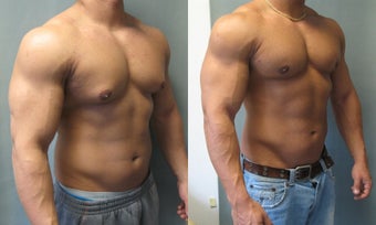 Gynecomastia Surgery