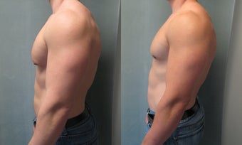 Gynecomastia