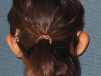 Otoplasty