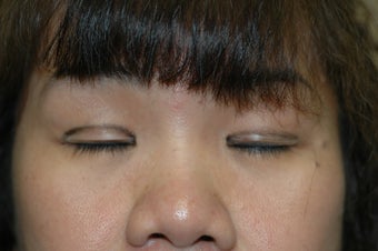 Asian eyelid surgery --  Double lid crease procedure