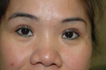 Asian eyelid surgery --  Double lid crease procedure