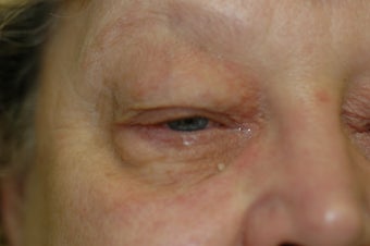 Bilateral upper and lower eyelid surgery