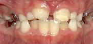 Two-Phase Orthodontic Treatment
