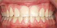 Two-Phase Orthodontic Treatment