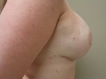 Breast Reconstruction after bilateral nipple sparring mastectomy
