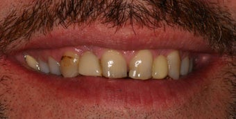 Full Mouth Reconstruction