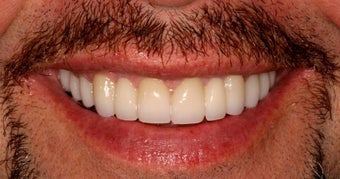 Full Mouth Reconstruction
