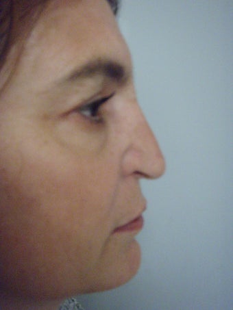 4th Revision Rhinoplasty