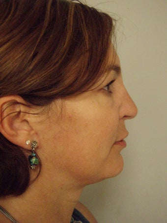 4th Revision Rhinoplasty