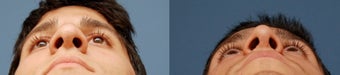 Rhinoplasty, Ethnic Iranian