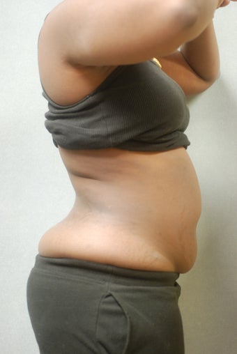 Upper and lower Abdomen & Flanks