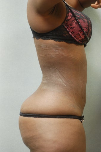 Upper and lower Abdomen & Flanks